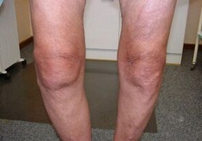 How to treat knee joints
