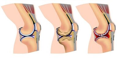 The stage of joint development of knee joints