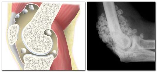 Chondromatosis with hip pain