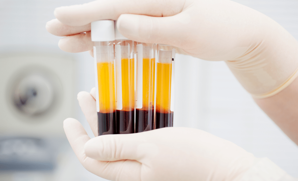 Platelet Rich Plasma for PRP Treatment of Arthritis