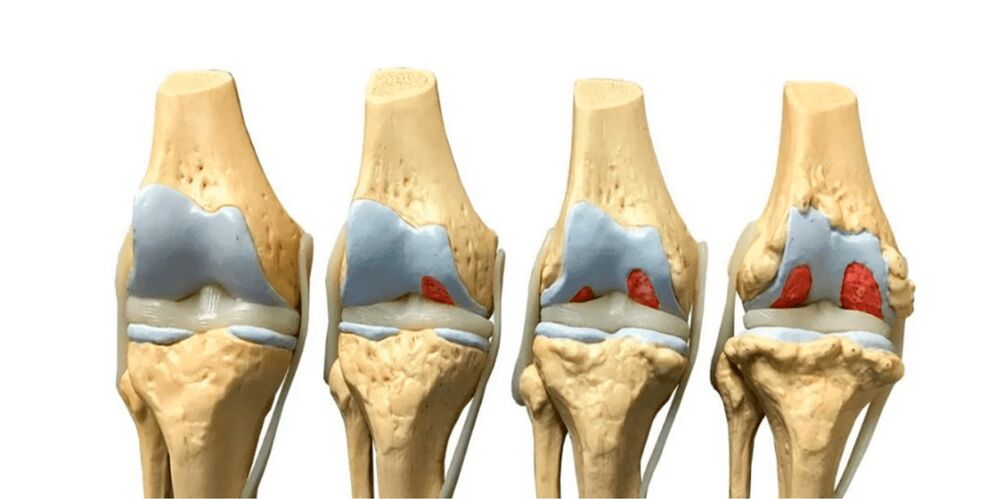 Degree of arthritis in the joint